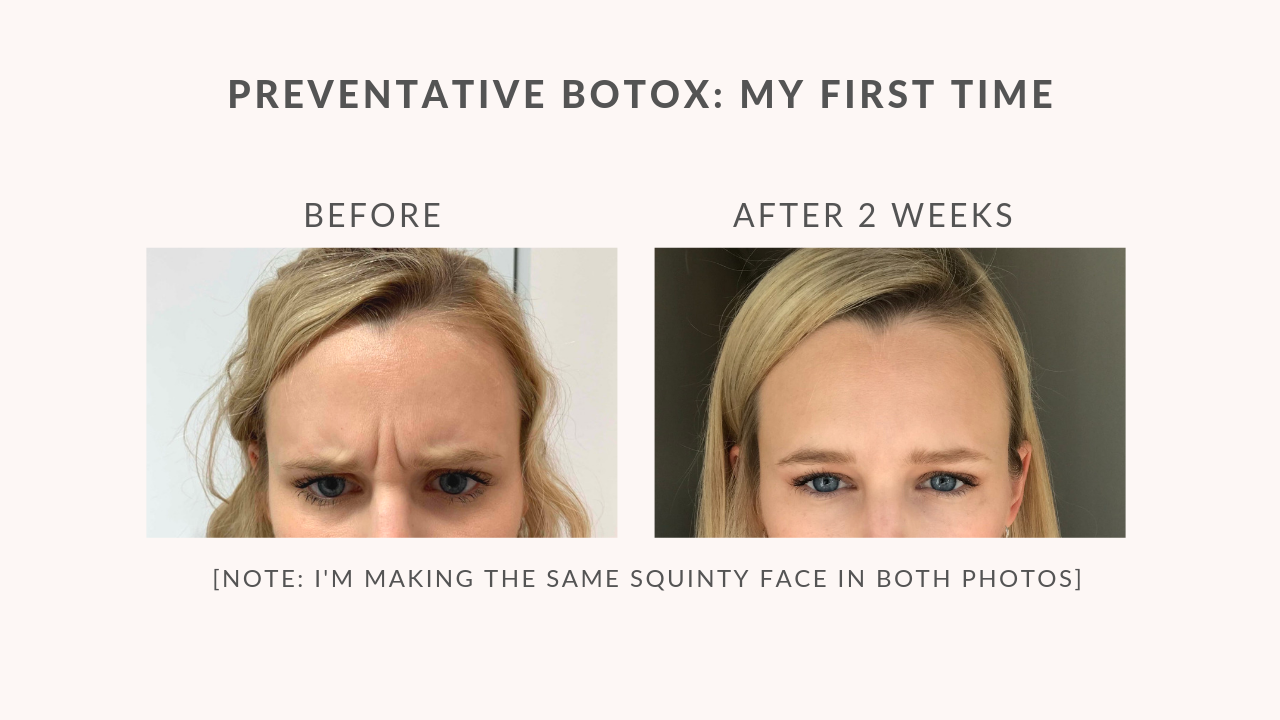 first-time getting preventative botox before and after